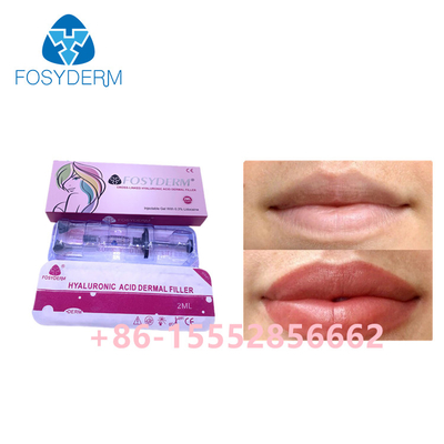 Hautfüller-Hyaluronsäure 2ml Fosyderm für Lippenverbesserung