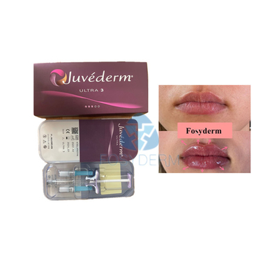 Voluma Hyaluronsäure-Hautfüller Fosyderm zur Lippenverbesserung