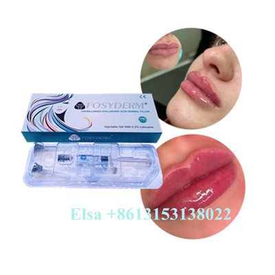 Hyaluronsäure-Gel-Einspritzung Juvederm-Lippenfüller-Cer alterndes Anti1ml 2ml 5ml
