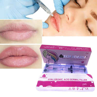 Hautfüller Hyaluronsäure Fosyderm für Gesichts-Lippeneinspritzung 24mg/Ml