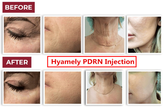 Serum des Hyamely-Zellen-Regations-Haut-Verstärkerpdrn für den Hals, der Gesichtseinspritzung weiß wird
