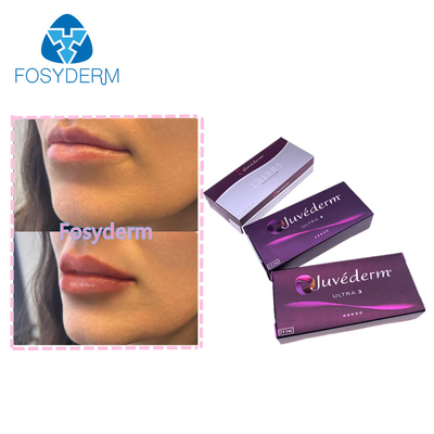 Lippenverstärker Filler 2*1ml Juvederm Hyaluronsäure-Injektion