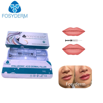Hyaluronsäure Injektionsfiller 1 ml 2 ml zur Lippenvergrößerung