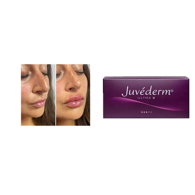 Juvederm 2*1ml Kreuzverknüpfte Hautfiller gegen Falten Gesichtsfiller