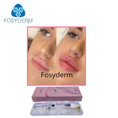 Hyaluronsäure-Einspritzungs-Hautfüller Fosyderm-Ästhetik-1ml für Lippenverbesserung
