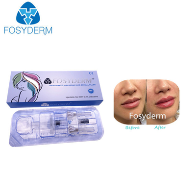Korea-Hyaluronsäure-Hautfüller für Lippenvermehrungs-Einspritzung