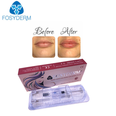 Korea-Hyaluronsäure-Hautfüller für Lippenvermehrungs-Einspritzung