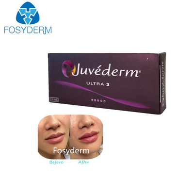 Juvederm ultra 3 1 ml * 2 Hyaluronsäure-Hautfüller-Lippeneinspritzungen