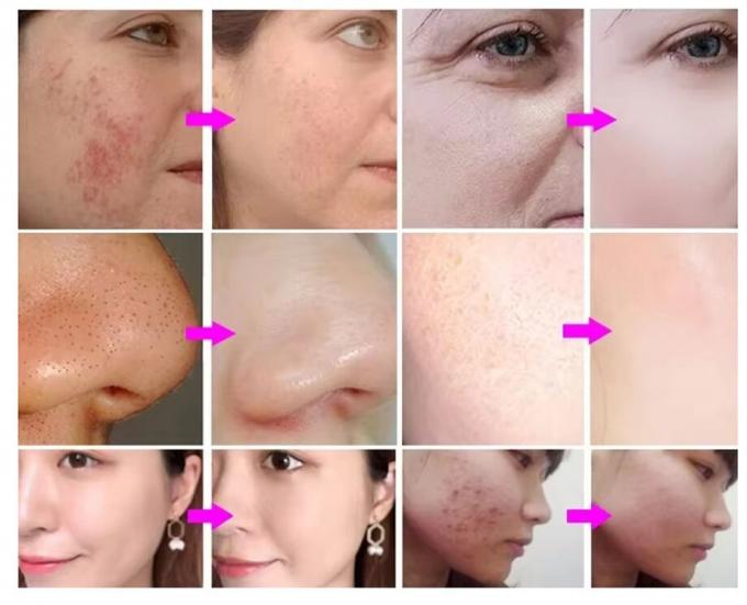 Hydra Peeling Gesichtshydro Kleines Blasenwasser Hydro Aqua Gesichtsh2o2 Hydra-Maschine 2