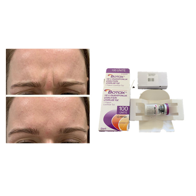 Weißer Botulinumgiftstoff Allergan alternde -Antieinspritzung