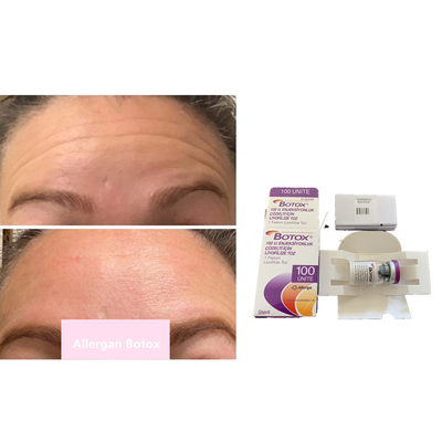 GIFTSTOFF-Pulver-Einspritzung des Falten-Abbau-100units Allergan  Botulinum