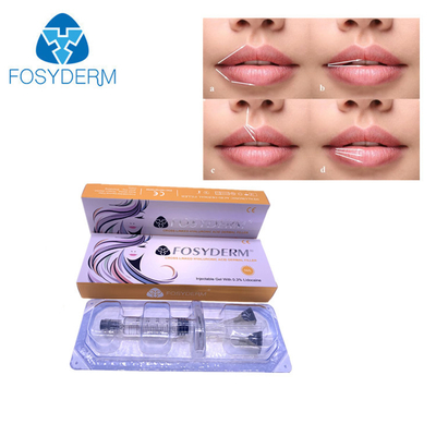 riechen Hautfüller-Einspritzung Hyaluronsäure 5ml Fosyderm für Lippen