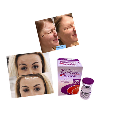 Hauteinheits-Botulinumpulver-Einspritzung füller-Antifalte Allergan  100