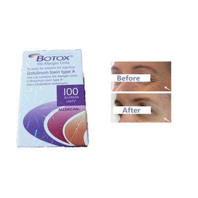 Allergan  Einheits-Stirn-Falten des Einspritzungs-Botulinumgiftstoff-100