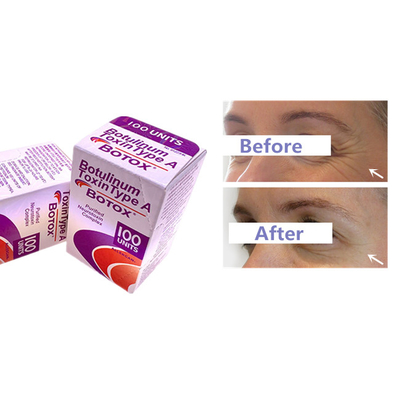 Botulinumeinspritzung giftstoff Allergan  für Falte entfernen
