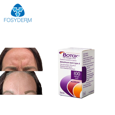 Anti-Falten- De Allergan 100 Einheiten Injektion