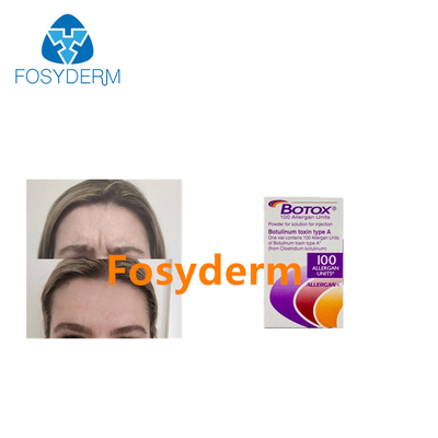 Allergan Botulinumtoxin-Injektionen entfernen Falten 100 Einheiten