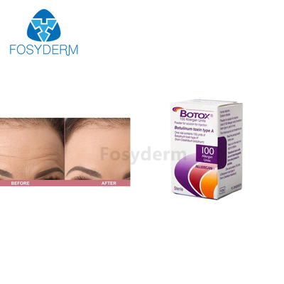 Botulinumgiftstoff-Einspritzung 100 Einheiten Allergan  für Antifalten