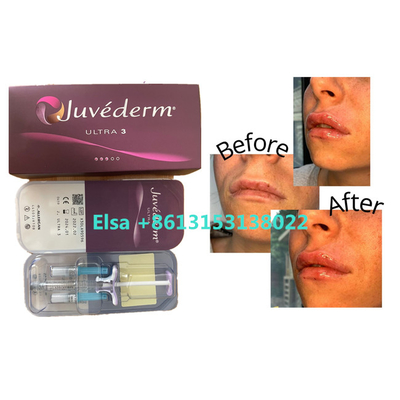 Hautfüller kosmetische Produkte Juvederm für Gesichts-Lippen