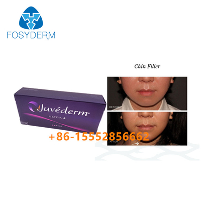 Chin Augmentation Hyaluronic Acid Facial-Füller Juvederm Ultra4 Haut-2ml