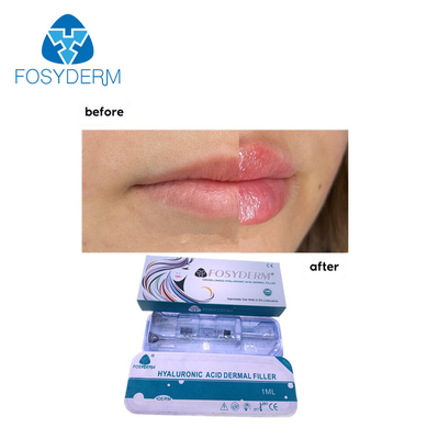Fosyderm Hauthyaluronsäure-Einspritzung lippender füller-1ml für Lippenverbesserung