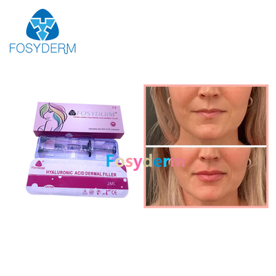 LIPPENfüller-Hyaluronsäure-Lippenverbesserungs-Einspritzung Derm-Linie Fosyderm 2ml Haut