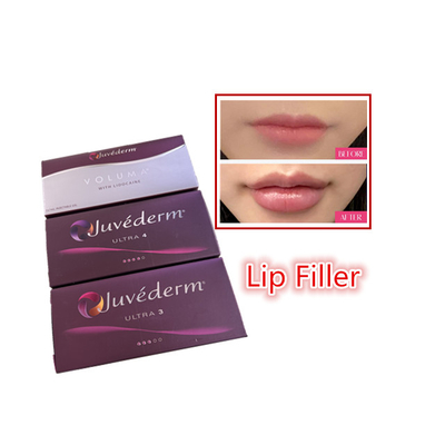 2 ml Hyaluronsäure-Kreuzverknüpfte Hautfüllmittel Juvederm Lippenfüllmittel Injektionen