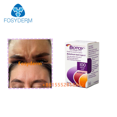 Entfernen Sie Falten Injektion Allergan Botulinum Toxin  Typ A 100 Einheiten