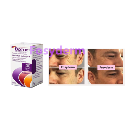 100 Einheiten Botulinumtoxin Allergan Anti Falten Injektion  Typ A