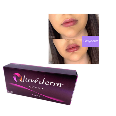 2 ml Juvederm Hyaluronsäure Hautfiller Faltenfiller Kinn Lippen Ultra 3