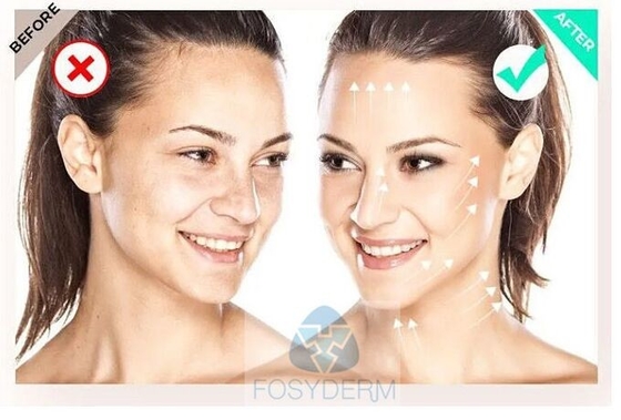 Gefülltes  135 HA Mesotherapie-Serum FILORGA 5*3 ml Hautverjüngungsmittel