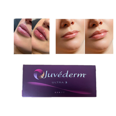 Juvederm Hyaluronsäure Hautfüllmittel gegen Falten Gesichts- und Lippenfüllmittel