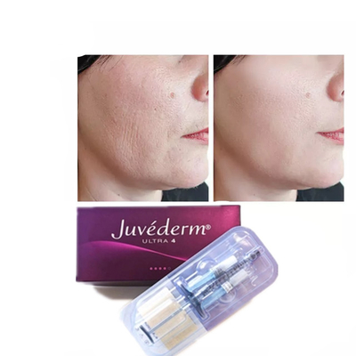 Juvederm Hyaluronsäure Hautfiller Anti-Aging 2*1ml Gesichtsfiller