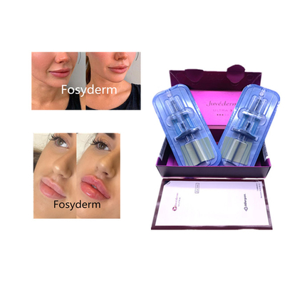 Juvederm Hyaluronsäure Hautfiller Anti-Aging 2*1ml Gesichtsfiller