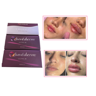 Hautpflege-Injektionen Lippenreiniger Juvederm Hyaluronsäure Hautfiller für das Gesicht