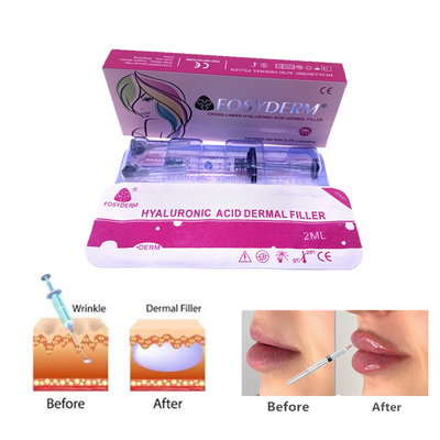 Fosyderm 2 ml Hyaluronsäure Gel Dermalfiller Injektionen für die Hautpflege des Gesichts und der Nase