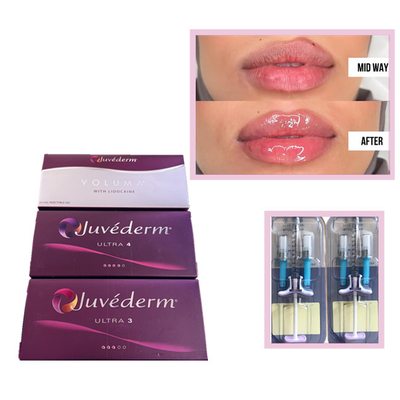 Juvederm Voluma Ultra3 Ultra4 HA Gel Füllstoffe 2 ml Hyaluronsäure