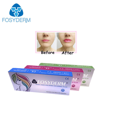 Gel 1 ml Hyaluronsäure-Füllmittel zur Faltereduzierung und Gesichtsformung