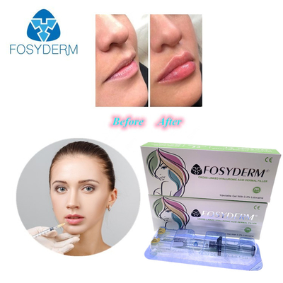 Gel 1 ml Hyaluronsäure-Füllmittel zur Faltereduzierung und Gesichtsformung