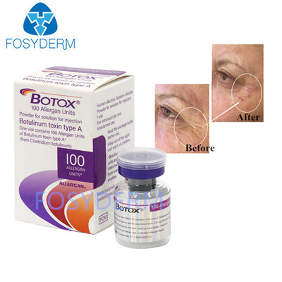 100 Einheiten Botulinum-Anti-Falten-Toxin Allergan-Injektions- zur Anti-Aging-Behandlung