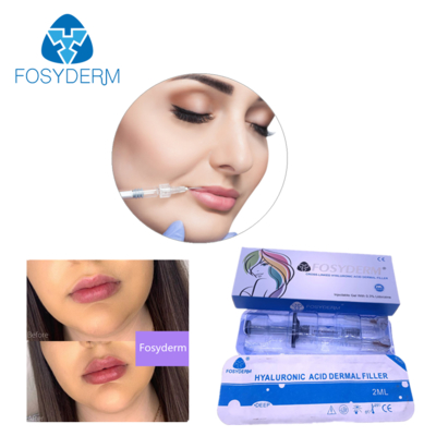 Hyaluronsäure Filler 24 mg/ml für Gesicht Lippen Wange Kinn