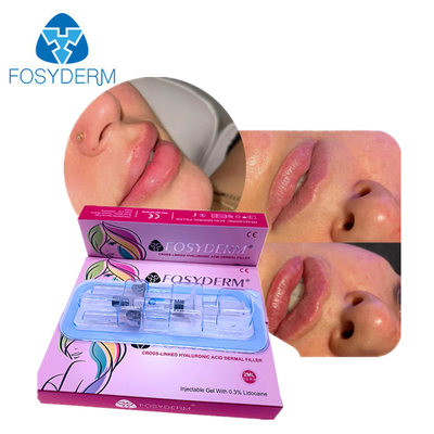Gesichtsverjüngung HA Hautfüllmittel für das Gesicht Kinn Wange Lippen Körper Bestie Gesäß