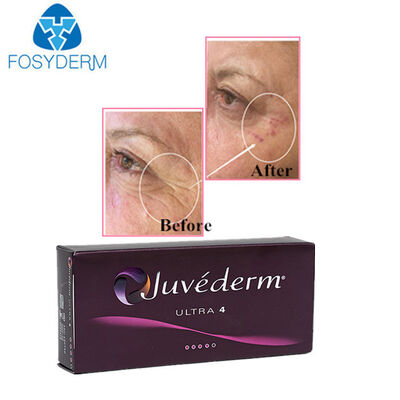 Juvederm Hyaluronic acid dermal filler for Lips Nose Face