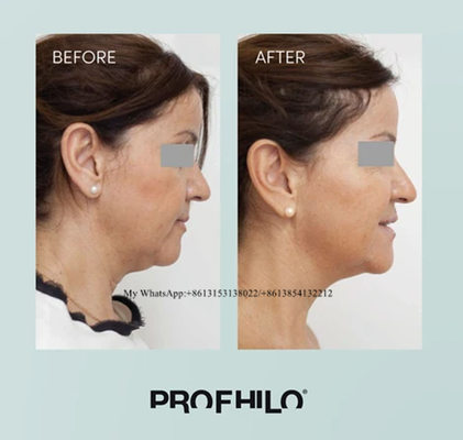 Profhilo Injectable HA Filler Mesotherapy Solution Profhilo H+L 2ml