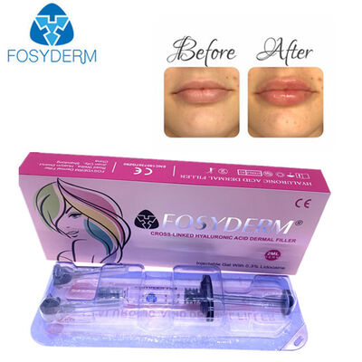 Hyaluronic Acid Dermal Filler Face Lifting 1ml 2ml