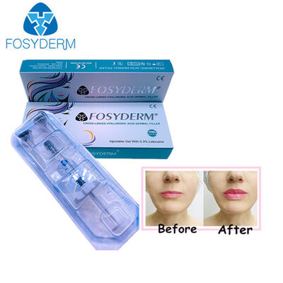 Hyaluronic Acid Dermal Filler Anti Wrinkles Nose Up Lips Augmentation