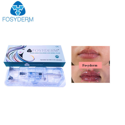 Hyaluronsäure-Hautfüller 1ml Derm für Lippen-CER Bescheinigung