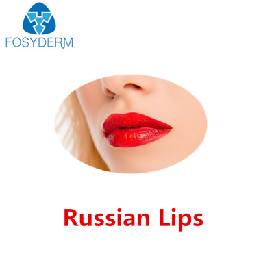 Juvederm ultra 3 Hyaluronsäure-Hautfüller-russische Lippen mit Lidocaine