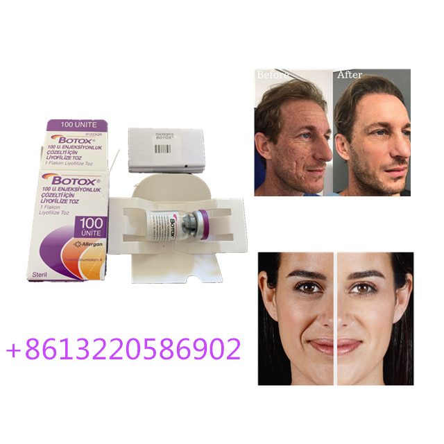 Alternde Antieinspritzung 100units Allergan  schreiben eine Antifalte