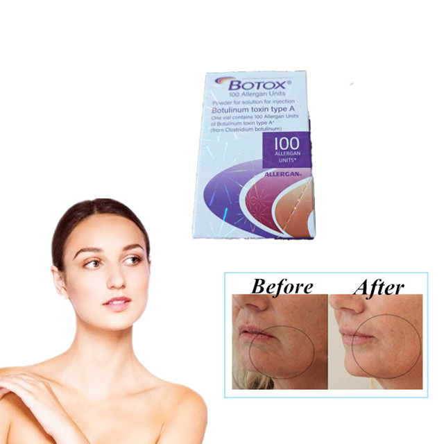 Allergan  100 Einheiten Typen Botulinumtoxin-Injektion Anti-Falten